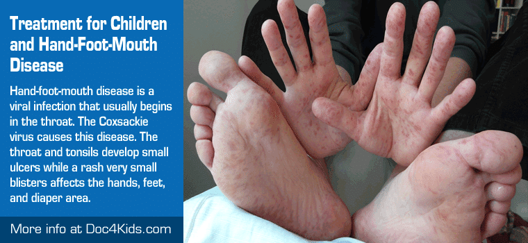 Treatment for Children and Hand-Foot-Mouth Disease