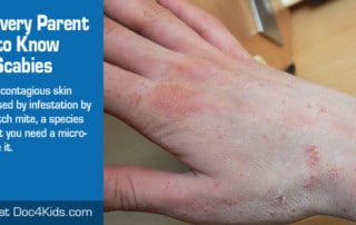 What Every Parent Needs to Know About Scabies | Hand with scabies