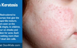 What is Keratosis Pliarus