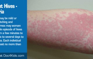 All-about-Hives-Urticiaria